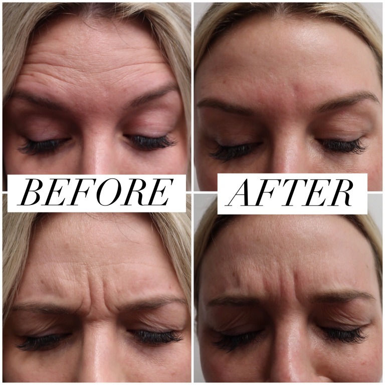 Houston blogger So Sage Blog's before & after botox results